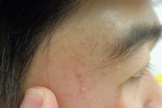 Acne Vulgaris